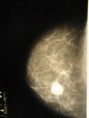 /album/zanimatelnoe-foto/fibroadenoma-1-jpg/